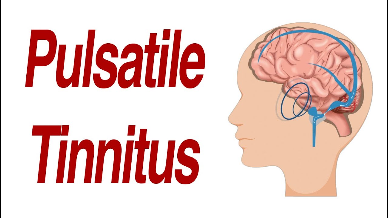 Pulsatile Tinnitus